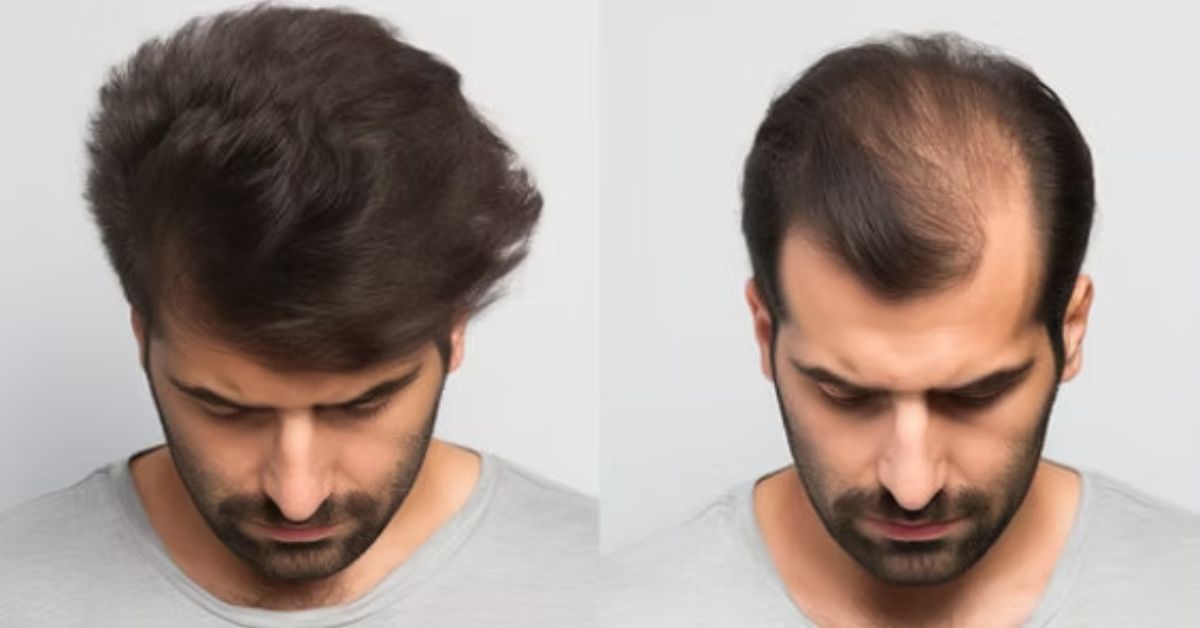 Hair Loss Treatment for Men