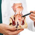 How to Fix Hemorrhoids Immediately