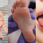 Hand Foot and Mouth Disease