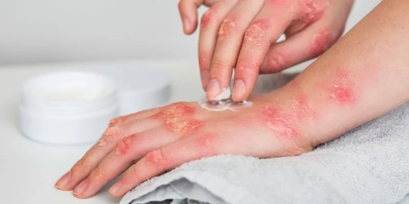 Treatment Options for Hand Foot and Mouth Disease