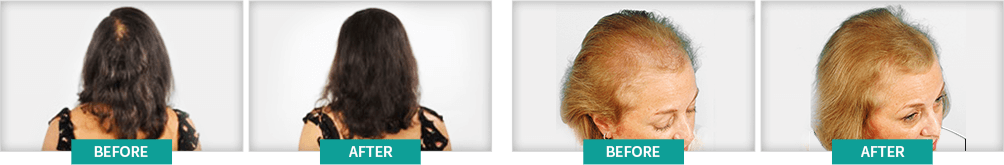 BioGrow Healthy Hair Hair Regrowth is Safe and Effective for Everyone